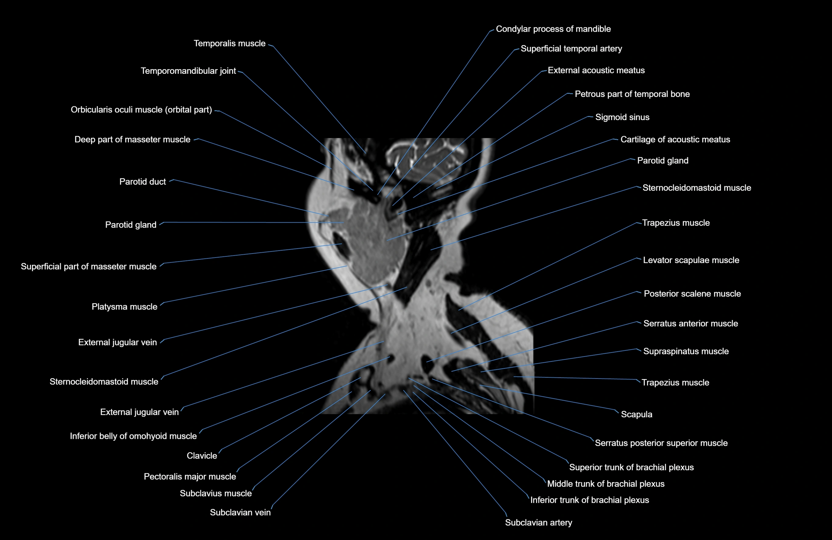 Neck MRI sagittal cross sectional anatomy 3D 1mm 3T radiology  image-img-00001-00036.webp